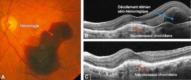 Medium,Hémorragie maculaire et néovaisseaux choroïdiens en DMLA exsudative active avec décollement séro-hémorragique.