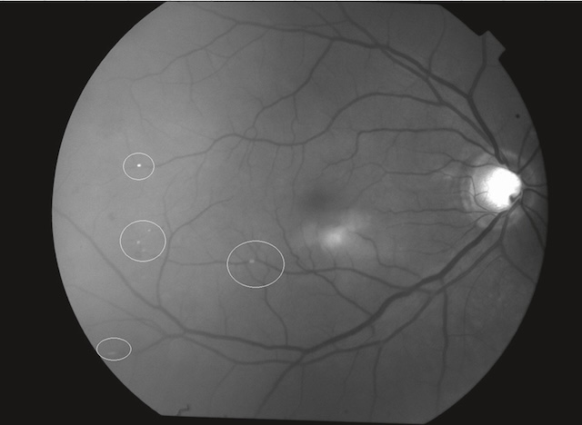 Zones hyperautofluorescentes rétiniennes suspectes, bien individualisées en imagerie du fond d’œil.
