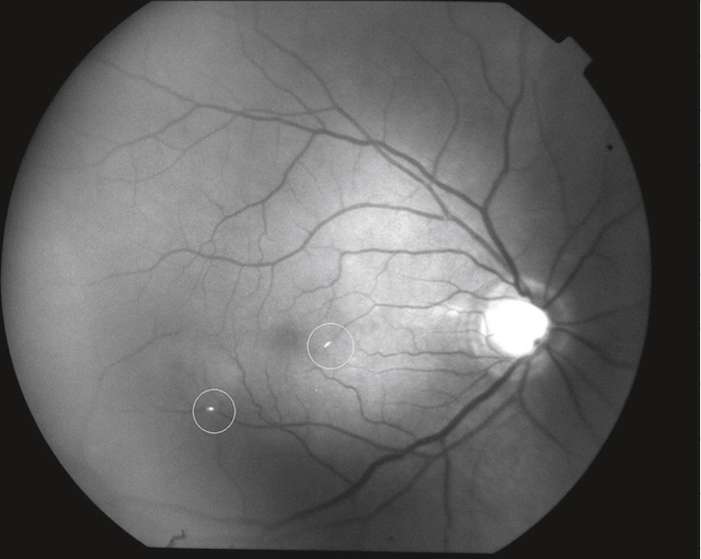 Foyers hyperautofluorescents discrets visibles en temporal inférieur sur autofluorescence rétinienne.
