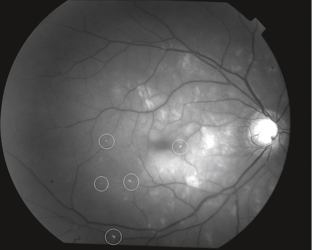 Multiples foyers hyperautofluorescents sur fond d’œil, avec altérations centrales diffuses.