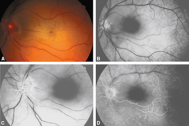 Images d’une occlusion aiguë de l’artère centrale rétinienne avec ischémie centrale et retard de remplissage angiographique.