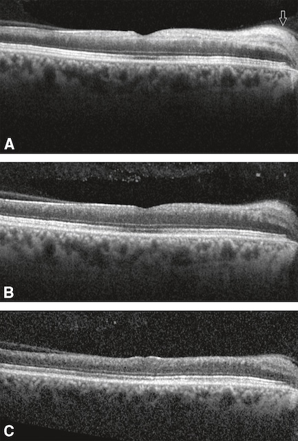 Coupes OCT maculaires sans anomalie significative, architecture rétinienne respectée.
