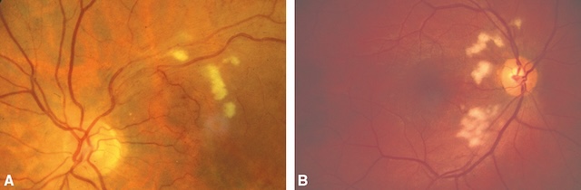Présence de nodules cotonneux péripapillaires évoquant une atteinte ischémique rétinienne.