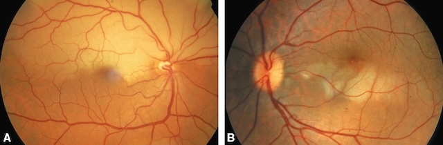 Ischémie rétinienne sectorielle évoquant une occlusion de branche artérielle.