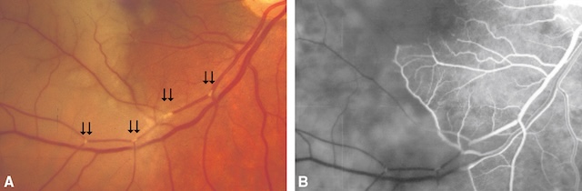 Emboles artériels visibles entraînant une ischémie rétinienne focale.