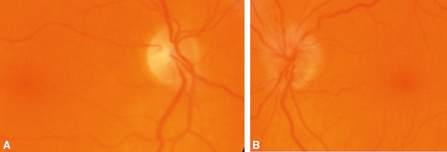 Papille normale à droite, œdème papillaire gauche évoquant une NOIA.