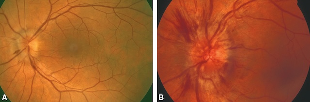 Image A atrophie optique Image B œdème papillaire aigu de NOIA.