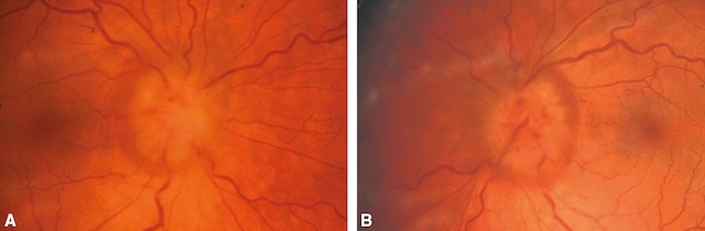 Œdème papillaire bilatéral par stase sans signes hémorragiques.
