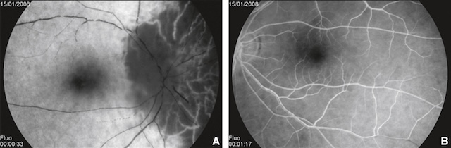Retard de perfusion papillaire avec hypofluorescence localisée traduisant une NOIA artéritique.