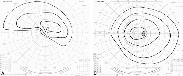 Champ visuel altéré en A par un scotome supérieur, plus conservé en B avec sensibilité centrale préservée.