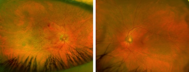 Aspect pathologique avec foyers pigmentés en A, fond d’œil normal sans lésion en B.