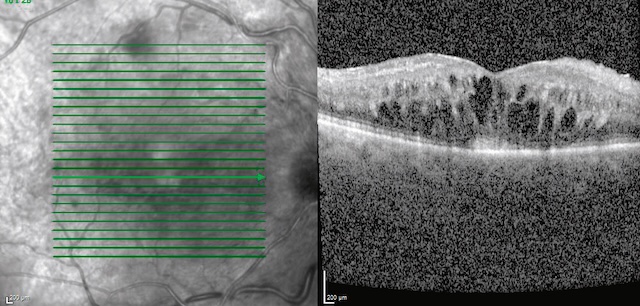 Présence d’un œdème maculaire cystoïde visible en coupe OCT centrale.