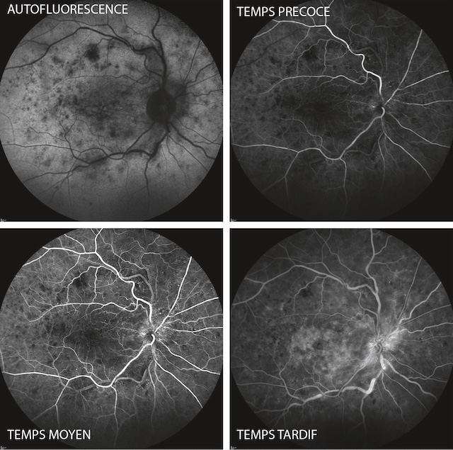 Évolution angiographique d’une atteinte maculaire avec fuite tardive et anomalies pigmentaires.