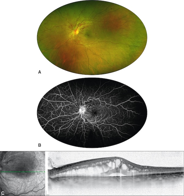 Œdème maculaire cystoïde avec fuite diffuse en angiographie et cavités intrarétiniennes à l’OCT.