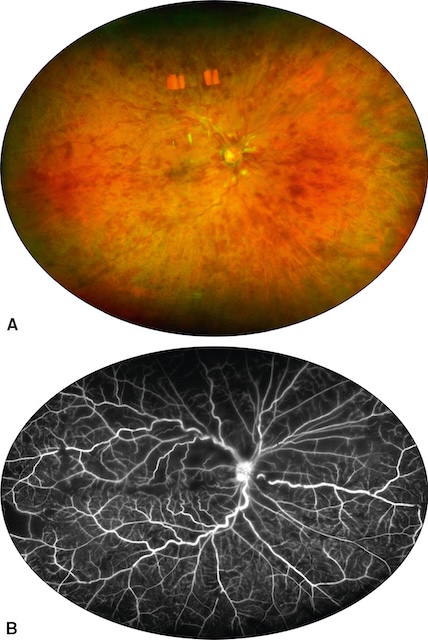 Aspect ischémique d’une OVCR avec hémorragies diffuses et non-perfusion capillaire périphérique.