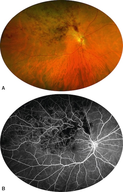 OBVR temporale supérieure avec hémorragie localisée et non-perfusion capillaire étendue.