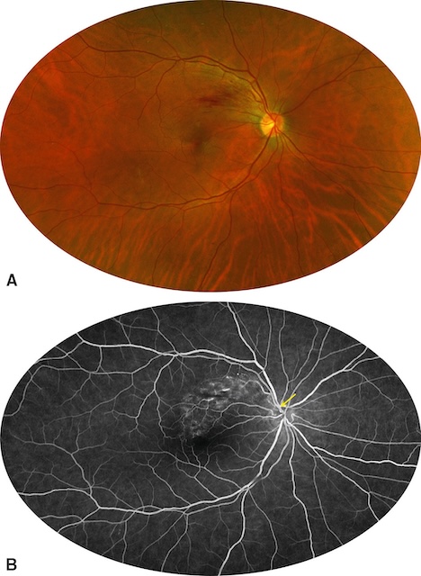 OBVR non ischémique avec hémorragies diffuses et fuite vasculaire modérée sans zones de non-perfusion.