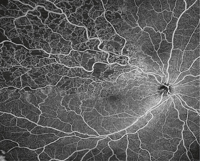 OBVR ischémique avec dilatation veineuse et larges zones d’ischémie capillaire temporale supérieure.