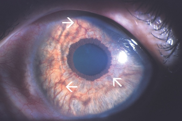 Vaisseaux anormaux visibles à la surface de l’iris, caractéristiques d’une néovascularisation irienne.