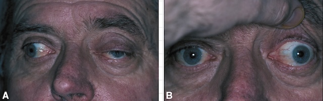 Images montrant un ptosis et une mydriase à gauche chez un patient avec déviation oculaire, évoquant une paralysie aiguë du nerf oculomoteur nécessitant une imagerie urgente.