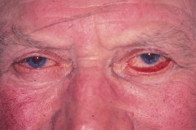 Image d’un ectropion sénile bilatéral chez un patient âgé, avec éversion visible des paupières inférieures.