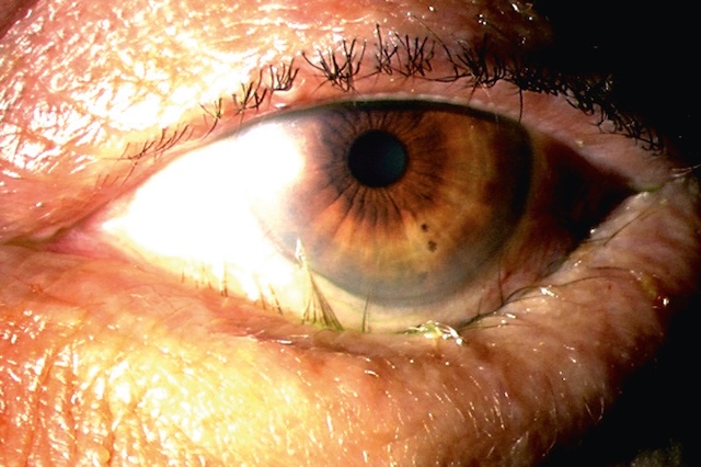 Image d’un patient présentant un entropion sénile compliqué de trichiasis avec cils orientés vers la cornée.