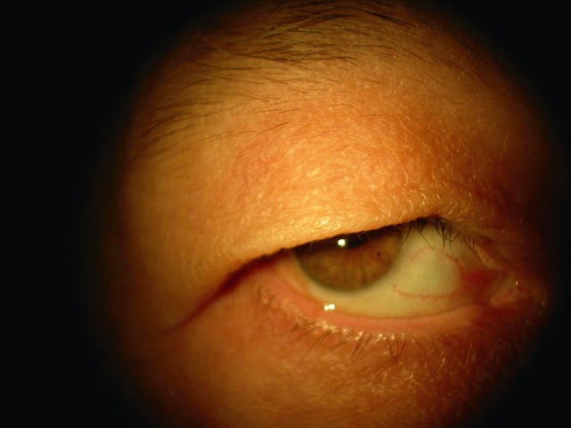 Image en gros plan montrant un excès de peau palpébrale supérieure couvrant partiellement l’œil, évocateur d’un dermatochalasis.