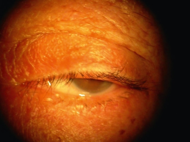 Image montrant un ptosis sénile avec affaissement de la paupière supérieure chez un patient âgé.