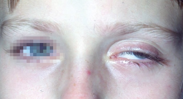Image montrant un ptosis congénital de l’œil droit chez un enfant, avec fermeture partielle de la paupière supérieure.
