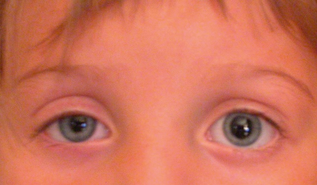 Image montrant un syndrome de Claude Bernard-Horner droit avec discret ptosis et myosis chez un enfant.