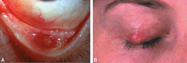 Images d’un chalazion avec extension interne (Partie A) et externe (Partie B) sur la paupière.
