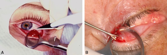 Images montrant l’incision conjonctivale (Partie A) et le curage du chalazion (Partie B) à l’aide d’instruments chirurgicaux.