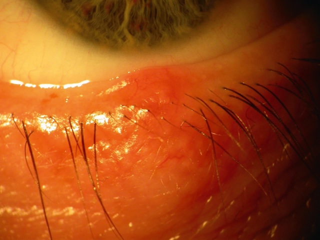 Image médicale montrant un orgelet inflammatoire rouge sur le bord libre inférieur de la paupière.