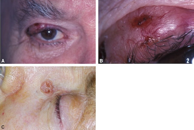 Trois images montrant différentes formes cliniques de carcinomes basocellulaires palpébraux.