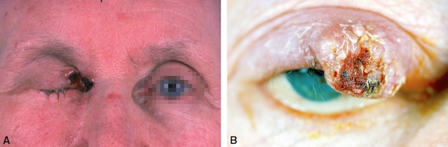 Deux images illustrant des carcinomes épidermoïdes palpébraux à différents stades évolutifs.