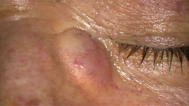 Lésion palpébrale évoquant un lymphome de MALT, sans signe inflammatoire.