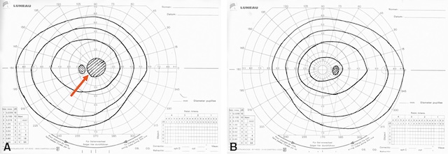 Champ visuel central altéré à droite, évocateur d’une névrite optique rétrobulbaire unilatérale.