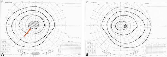 Scotome cæcocentral unilatéral évocateur d’une névrite optique rétrobulbaire.