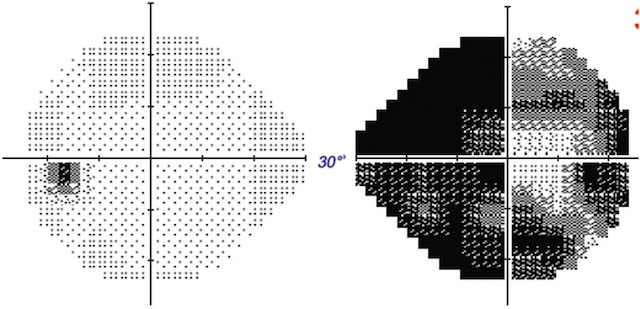Déficit diffus du champ visuel droit, compatible avec une NORB unilatérale.