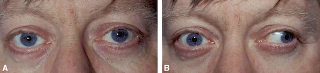 Adduction gauche déficiente et nystagmus controlatéral évoquant une paralysie internucléaire.