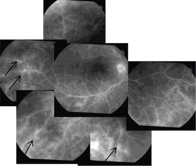Fuites vasculaires diffuses et gaines veineuses périphériques évoquant une uvéite intermédiaire.