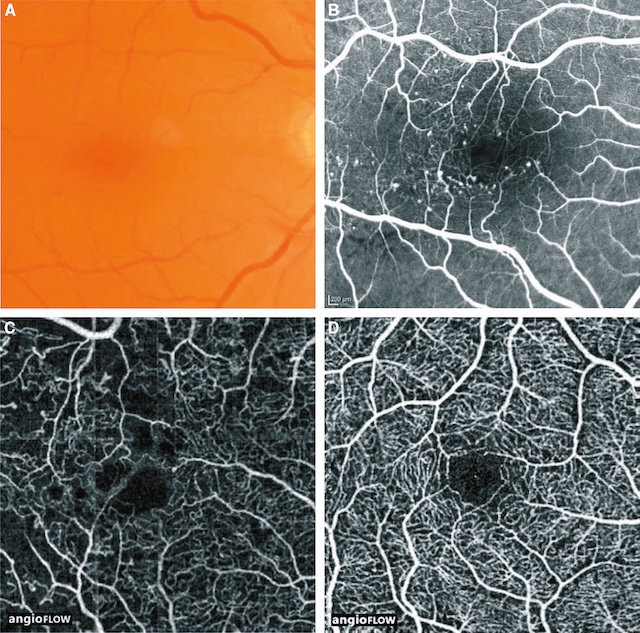 Zones maculaires ischémiques et microanévrysmes visibles en angiographie et OCT-A.