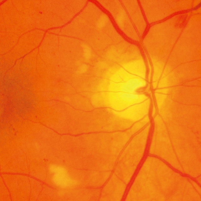 Nodule cotonneux péripapillaire avec hémorragies rétiniennes diffuses.