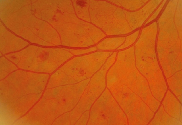 Hémorragies en taches diffuses avec AMIR dans un contexte de rétinopathie.