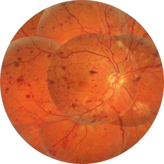 Hémorragies diffuses sur fond de rétinopathie diabétique non proliférante sévère.