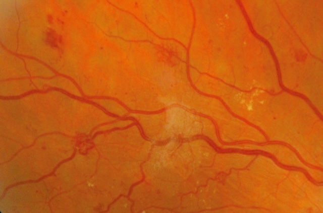 Présence de néovaisseaux prérétiniens sur fond de rétinopathie proliférante.