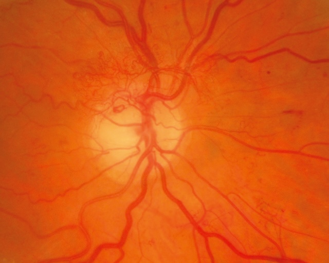 Prolifération néovasculaire prépapillaire sur papille optique, aspect prolifératif marqué.