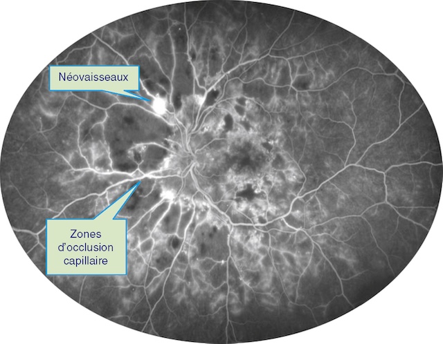 Néovaisseaux actifs et occlusions capillaires dans une rétinopathie diabétique proliférante.