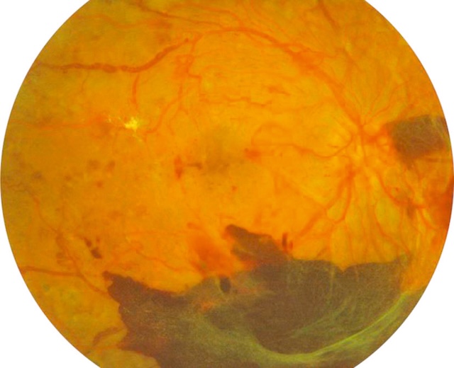 Image typique de rétinopathie diabétique proliférante avec vaste hémorragie prérétinienne.