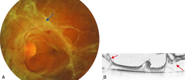 Fibrose prérétinienne et décollement tractionnel sur rétinopathie diabétique proliférante.